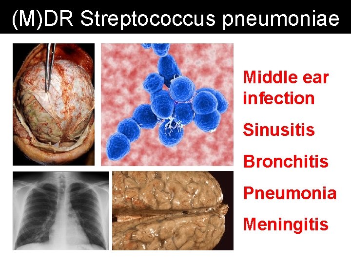 (M)DR Streptococcus pneumoniae Middle ear infection Sinusitis Bronchitis Pneumonia Meningitis 