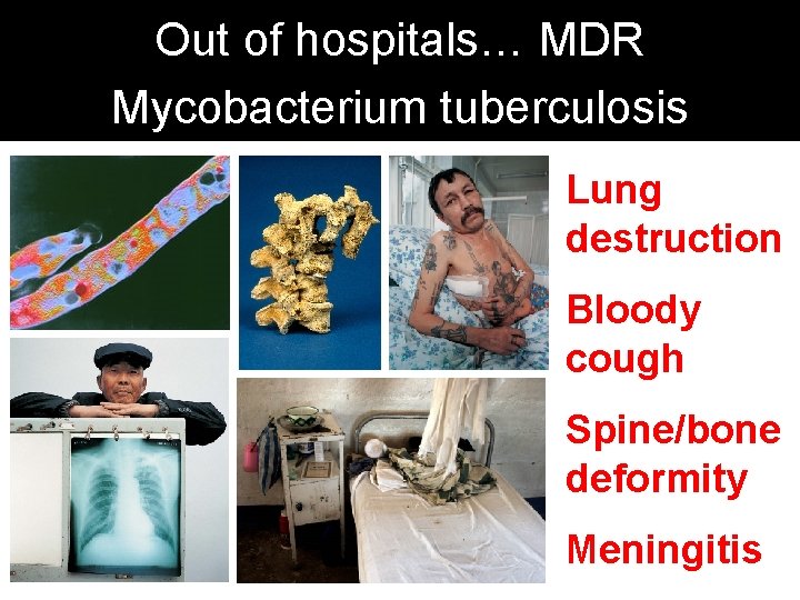 Out of hospitals… MDR Mycobacterium tuberculosis Lung destruction Bloody cough Spine/bone deformity Meningitis 