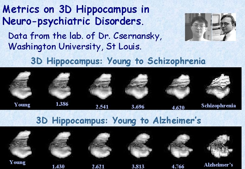 Metrics on 3 D Hippocampus in Neuro-psychiatric Disorders. Data from the lab. of Dr.