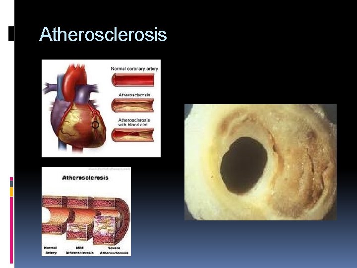 Atherosclerosis 