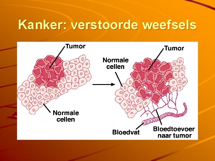 Kanker: verstoorde weefsels 