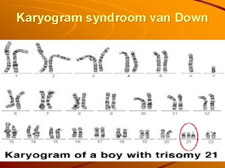 Karyogram syndroom van Down 