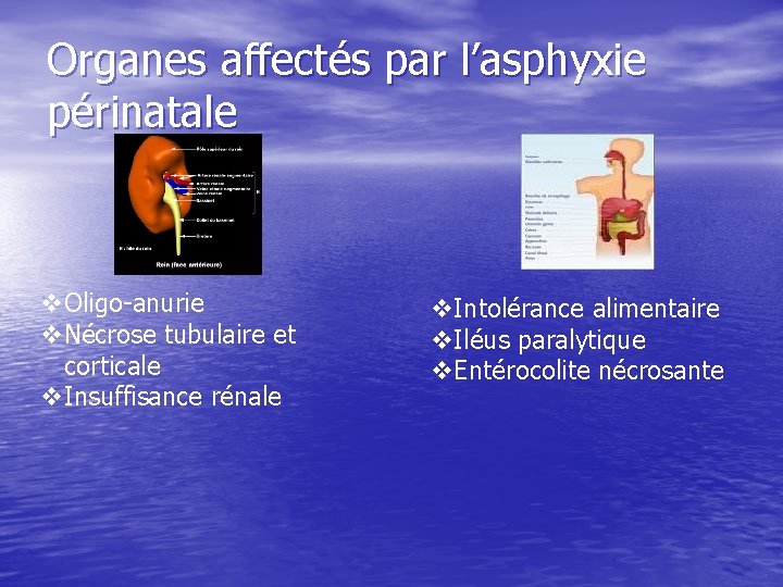 Organes affectés par l’asphyxie périnatale v. Oligo-anurie v. Nécrose tubulaire et corticale v. Insuffisance