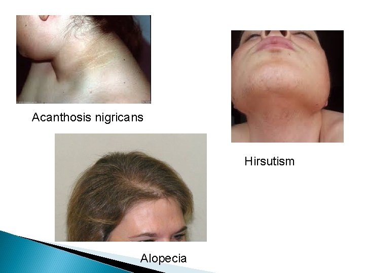 Acanthosis nigricans Hirsutism Alopecia 