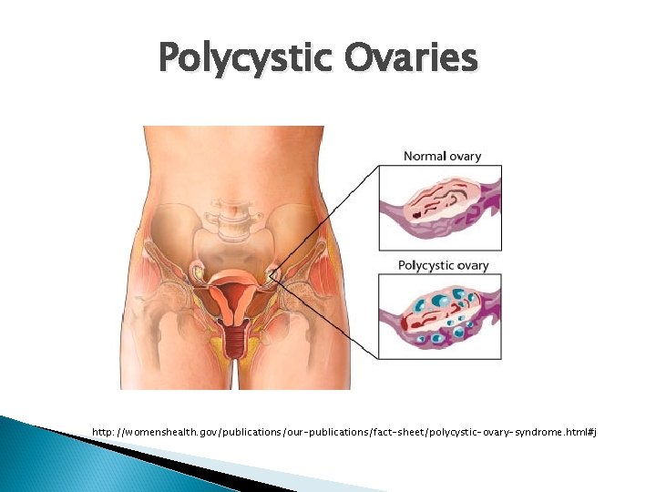 Polycystic Ovaries http: //womenshealth. gov/publications/our-publications/fact-sheet/polycystic-ovary-syndrome. html#j 