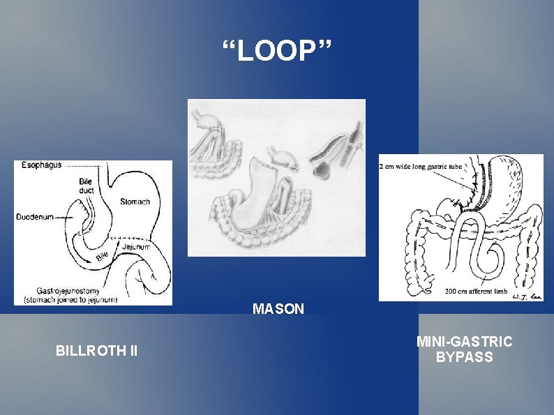 “LOOP” MASON BILLROTH II MINI-GASTRIC BYPASS 