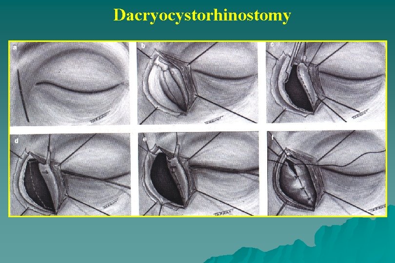 Dacryocystorhinostomy 