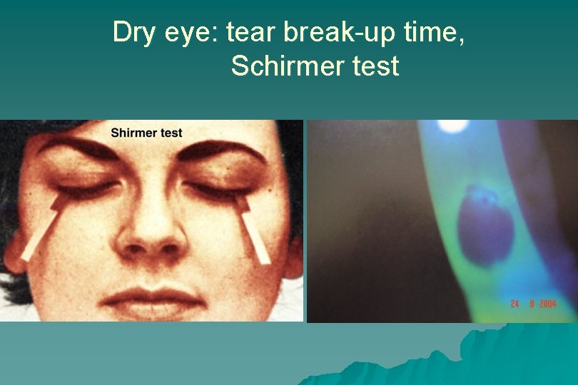 Dry eye: tear break-up time, Schirmer test 