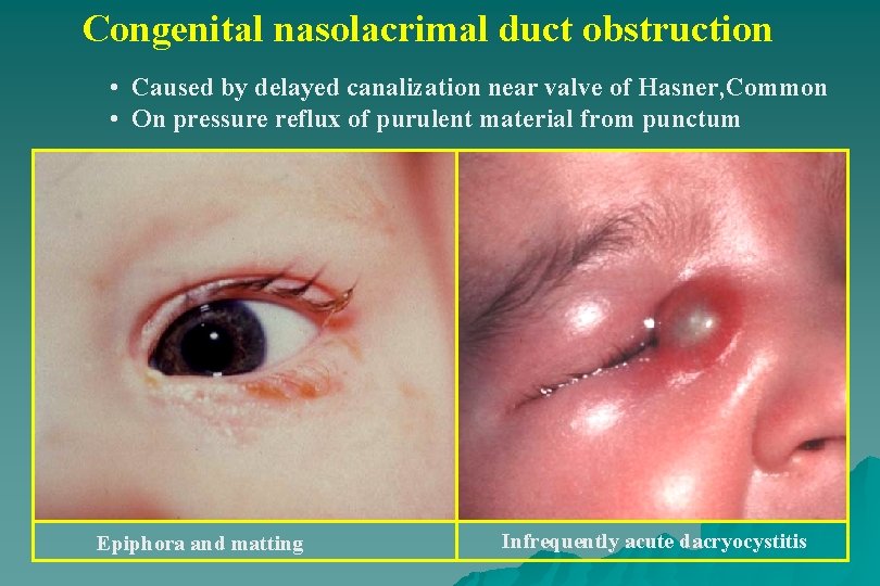 Congenital nasolacrimal duct obstruction • Caused by delayed canalization near valve of Hasner, Common