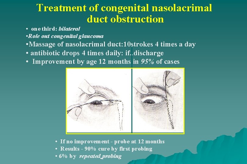 Treatment of congenital nasolacrimal duct obstruction • one third: bilateral • Role out congenital