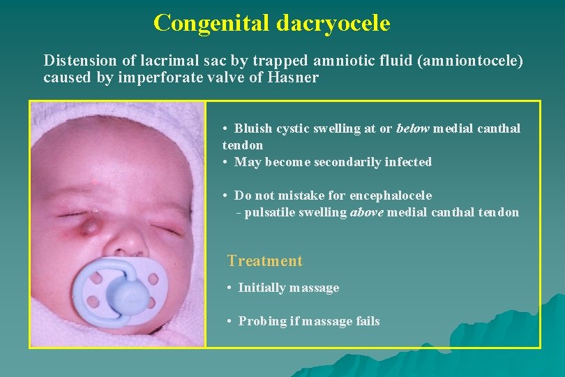 Congenital dacryocele Distension of lacrimal sac by trapped amniotic fluid (amniontocele) caused by imperforate