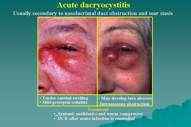 Acute dacryocystitis Usually secondary to nasolacrimal duct obstruction and tear stasis • Tender canthal