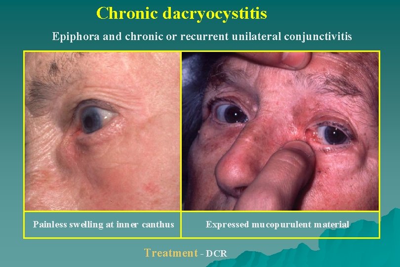 Chronic dacryocystitis Epiphora and chronic or recurrent unilateral conjunctivitis Painless swelling at inner canthus