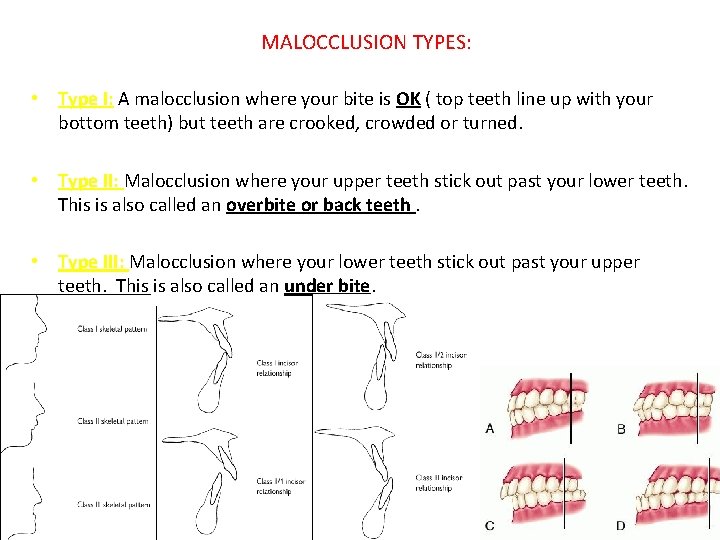 MALOCCLUSION TYPES: • Type I: A malocclusion where your bite is OK ( top