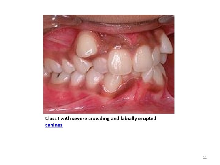 Class I with severe crowding and labially erupted canines 11 