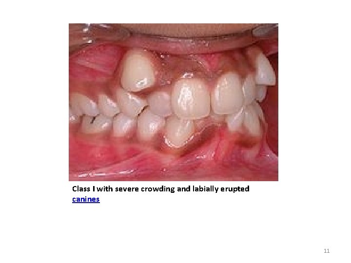Class I with severe crowding and labially erupted canines 11 Class I with severe crowding and labially erupted canines 11