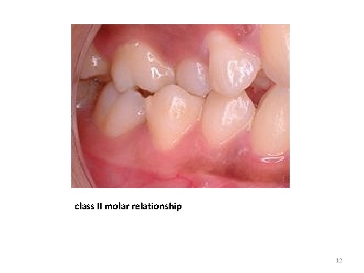 class II molar relationship 12 