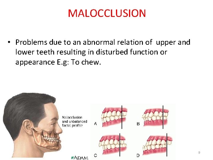 MALOCCLUSION • Problems due to an abnormal relation of upper and lower teeth resulting MALOCCLUSION • Problems due to an abnormal relation of upper and lower teeth resulting