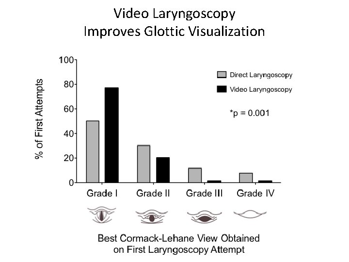 Video Laryngoscopy Improves Glottic Visualization 