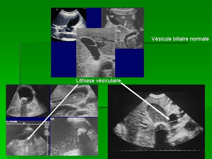 Vésicule biliaire normale Lithiase vésiculaire 