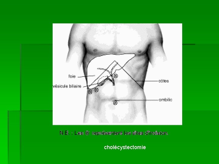 cholécystectomie 