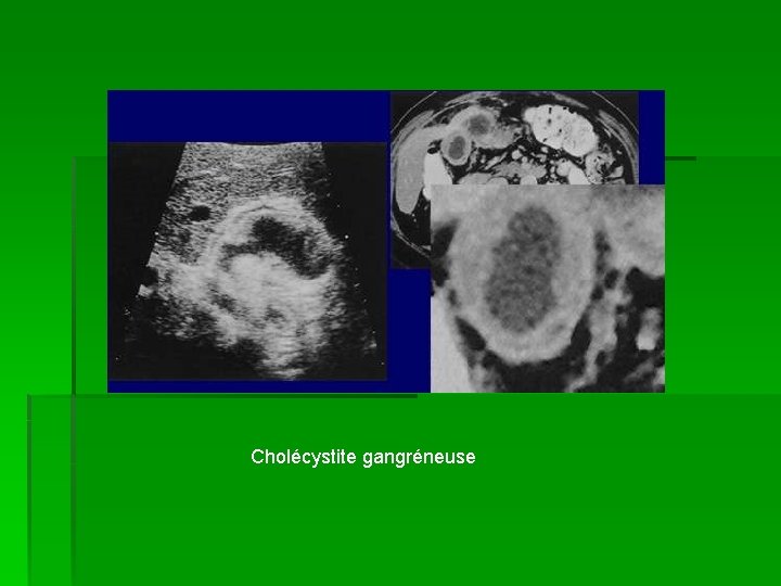 Cholécystite gangréneuse 