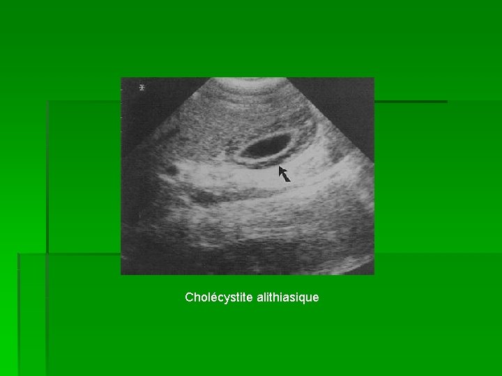 Cholécystite alithiasique 