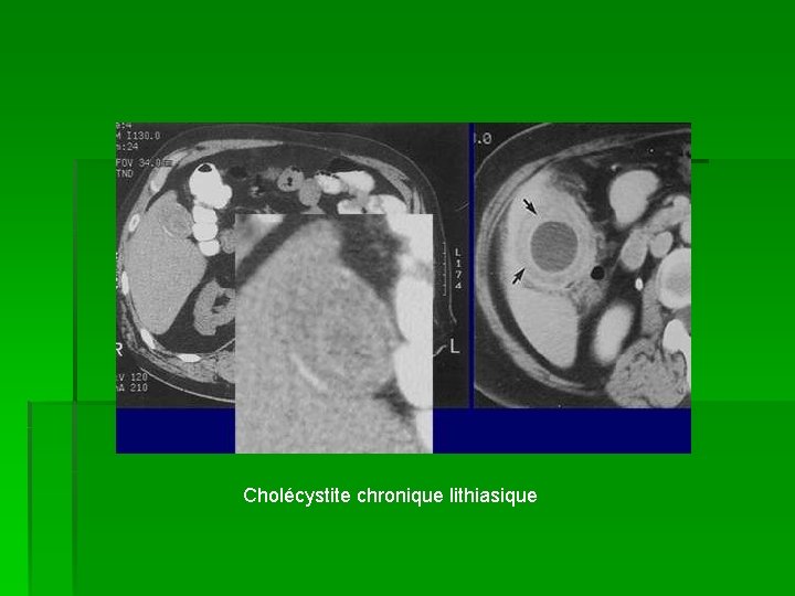 Cholécystite chronique lithiasique 