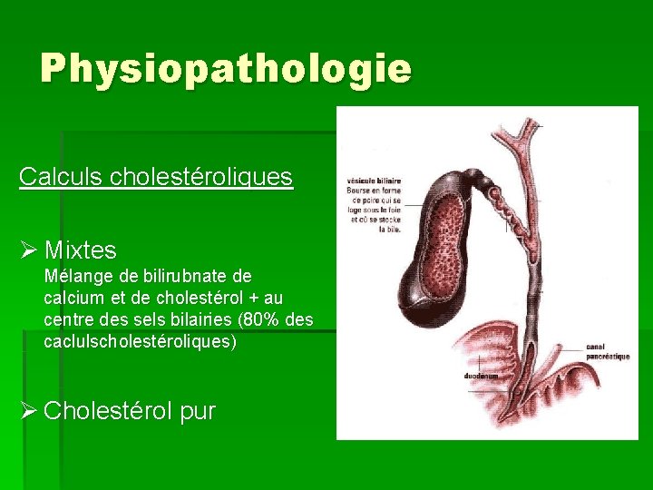 Physiopathologie Calculs cholestéroliques Ø Mixtes Mélange de bilirubnate de calcium et de cholestérol +
