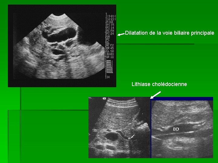 Dilatation de la voie biliaire principale Lithiase cholédocienne 