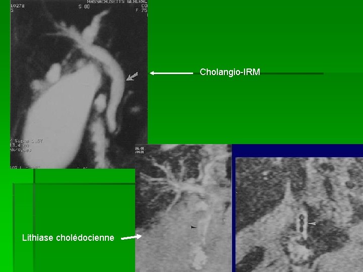 Cholangio-IRM Lithiase cholédocienne 