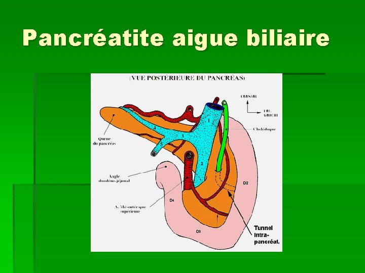 Pancréatite aigue biliaire 