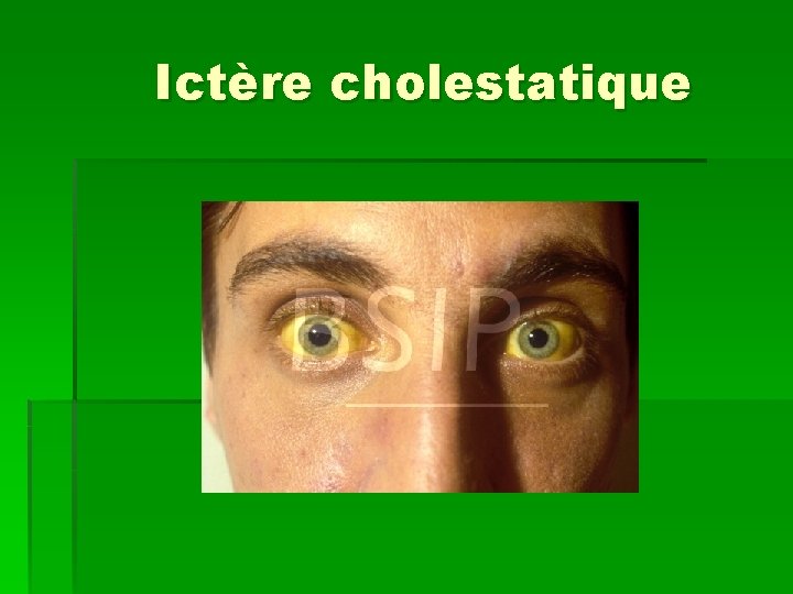 Ictère cholestatique 