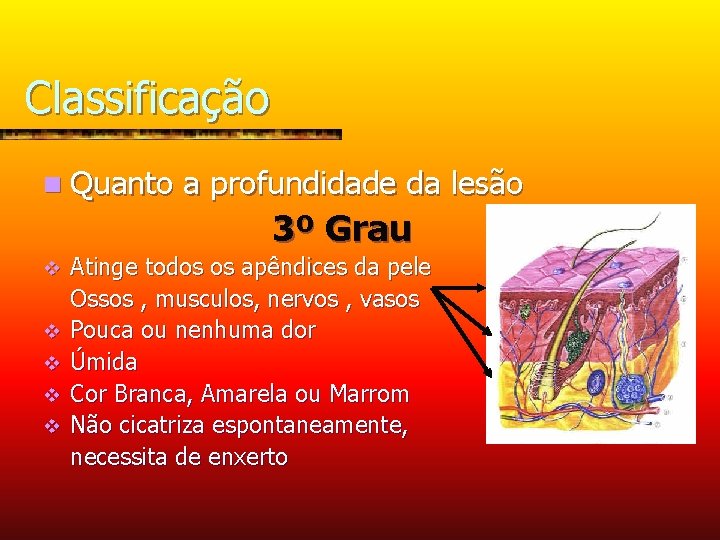 Classificação n Quanto a profundidade da lesão 3º Grau v v v Atinge todos