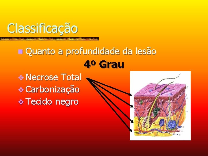 Classificação n Quanto a profundidade da lesão 4º Grau v Necrose Total v Carbonização