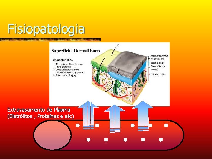 Fisiopatologia Extravasamento de Plasma (Eletrólitos , Proteínas e etc) 