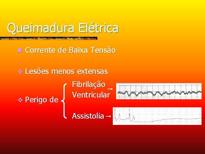 Queimadura Elétrica n Corrente de Baixa Tensão v Lesões v Perigo menos extensas de