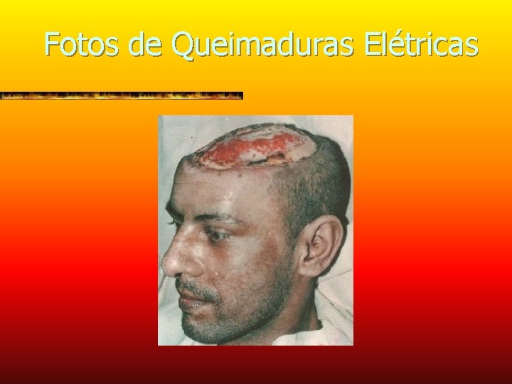 Fotos de Queimaduras Elétricas 