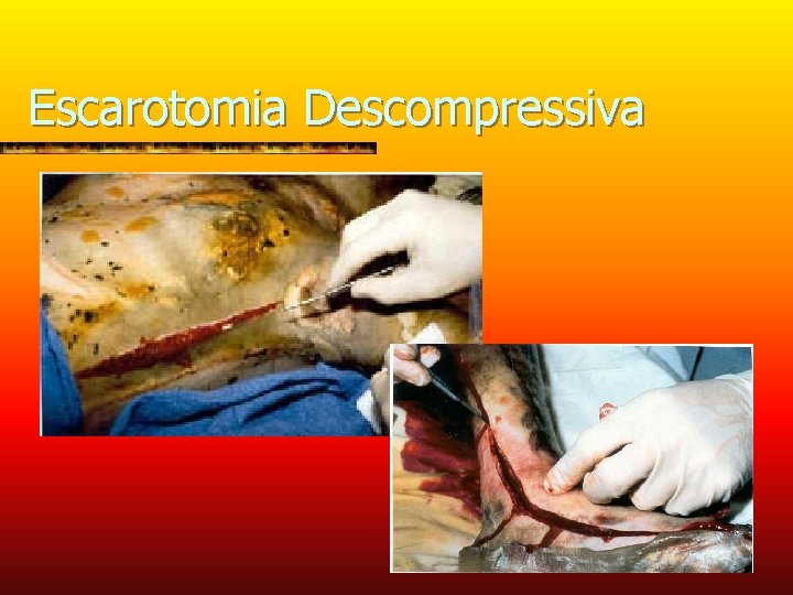 Escarotomia Descompressiva 