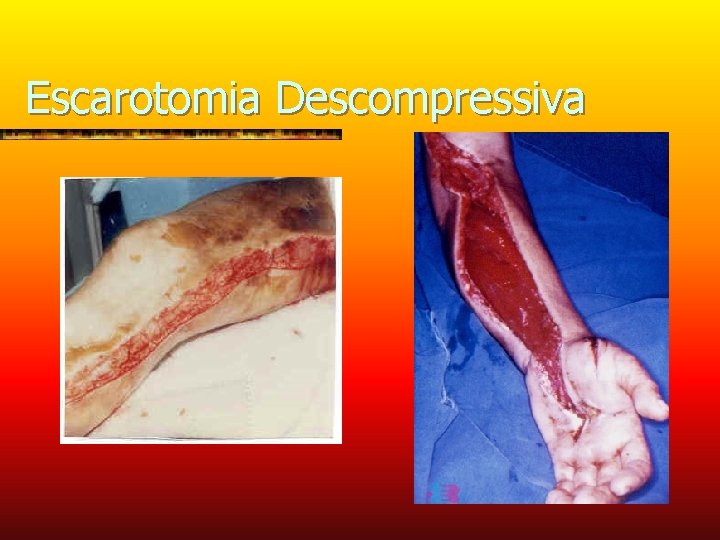 Escarotomia Descompressiva 