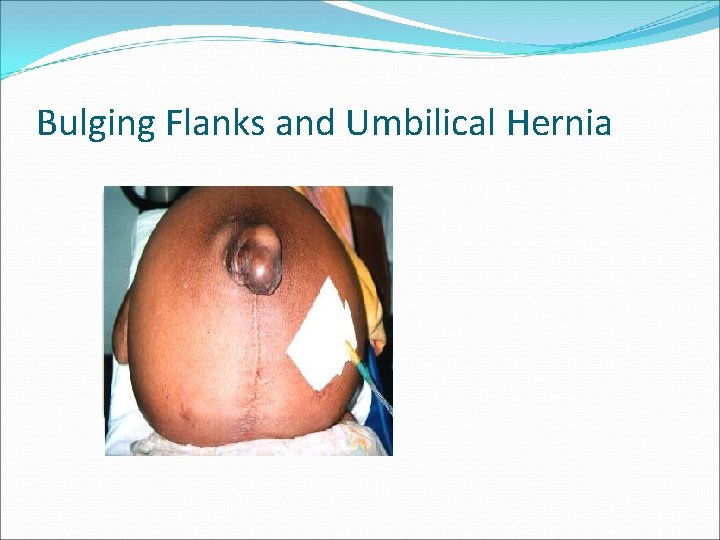 Bulging Flanks and Umbilical Hernia 