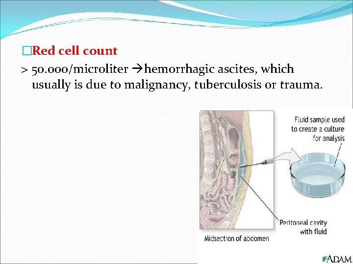�Red cell count > 50. 000/microliter hemorrhagic ascites, which usually is due to malignancy,