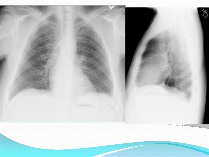 bilateral pleural effusions in a patient with ascites 