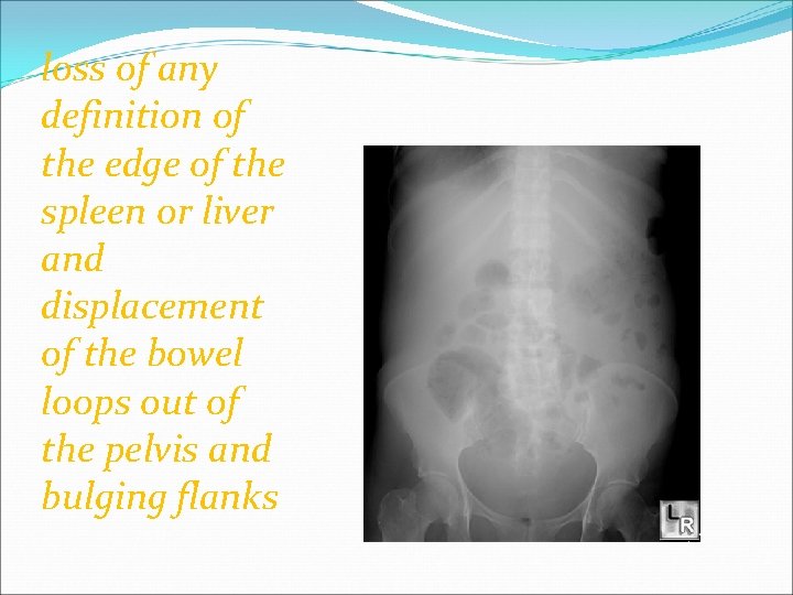 loss of any definition of the edge of the spleen or liver and displacement