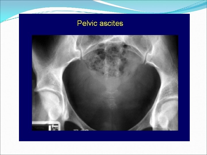Pelvic Ascites 