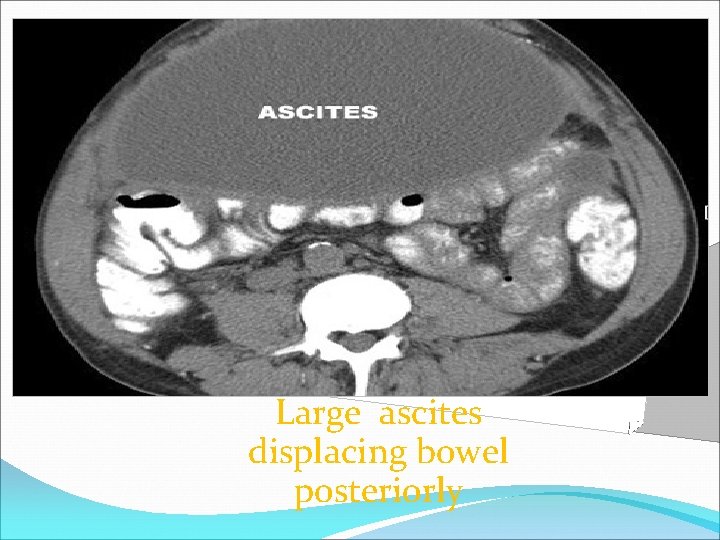 Large ascites displacing bowel posteriorly 