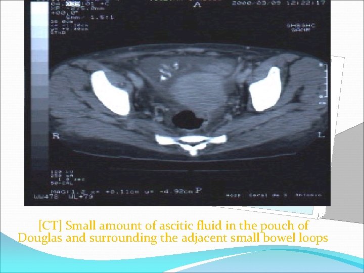 [CT] Small amount of ascitic fluid in the pouch of Douglas and surrounding the