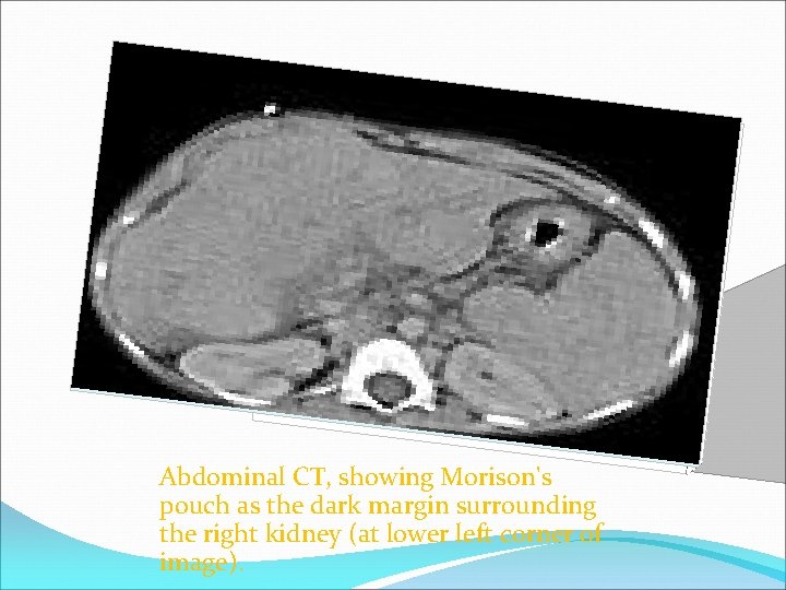 Abdominal CT, showing Morison's pouch as the dark margin surrounding the right kidney (at