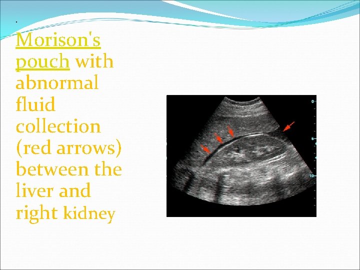 . Morison's pouch with abnormal fluid collection (red arrows) between the liver and right