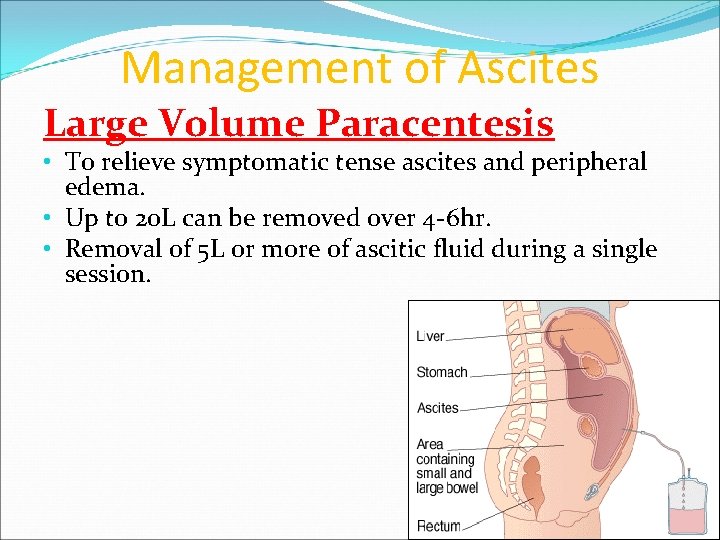 Management of Ascites Large Volume Paracentesis • To relieve symptomatic tense ascites and peripheral
